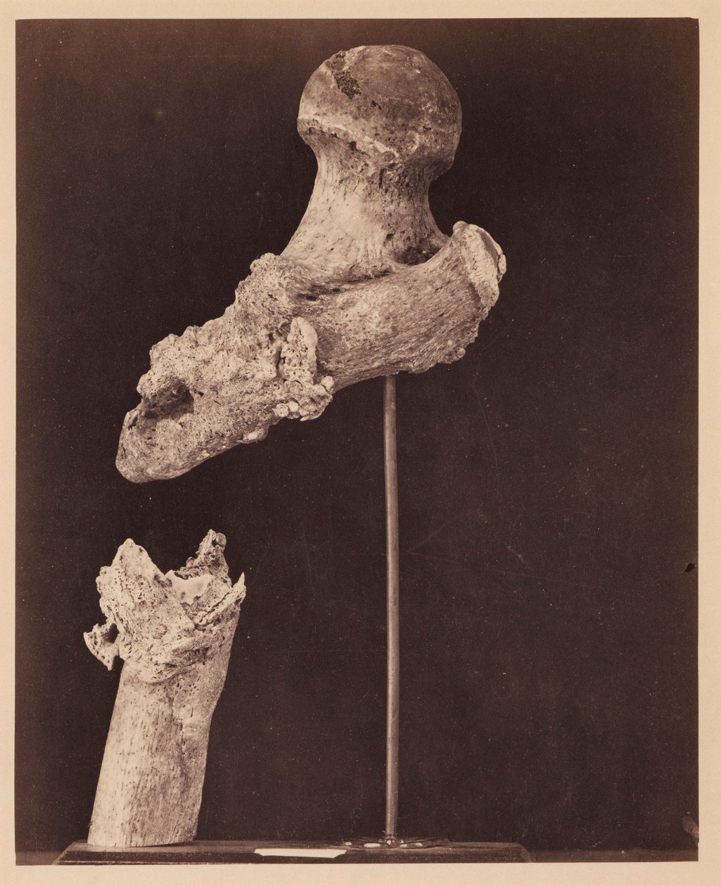 Tenente Goodwin, Falecido, Fratura de Tiro do Terço Superior do Fémur Direito, Sete Meses após o Ferimento, do Catálogo Fotográfico da Secção Cirúrgica de William Bell