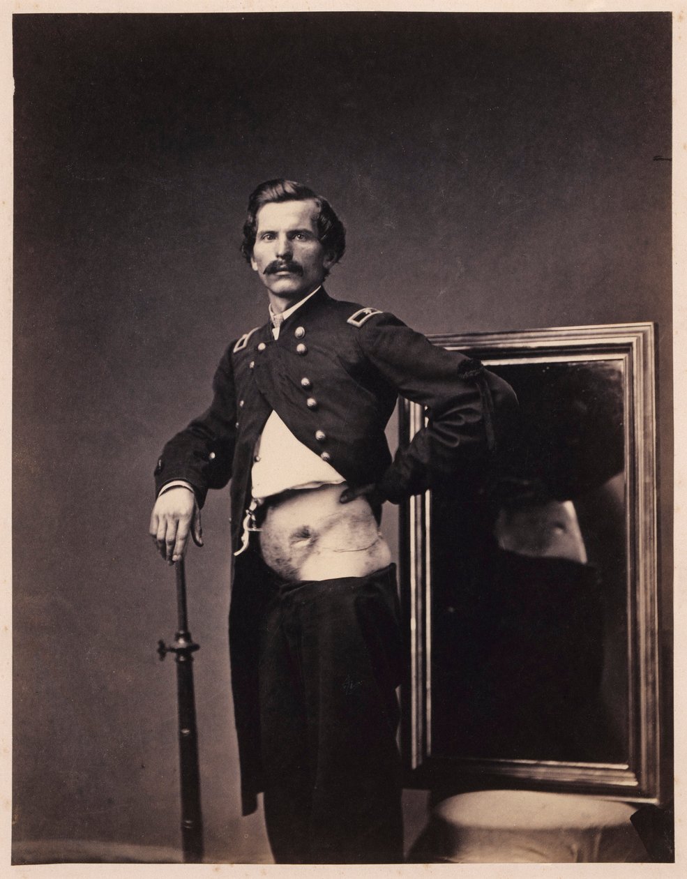 Major H. A. Barnum, Recuperação após um ferimento penetrante de bala no abdómen com perfuração do ílio esquerdo, do Catálogo Fotográfico da Secção de Cirurgia de William Bell