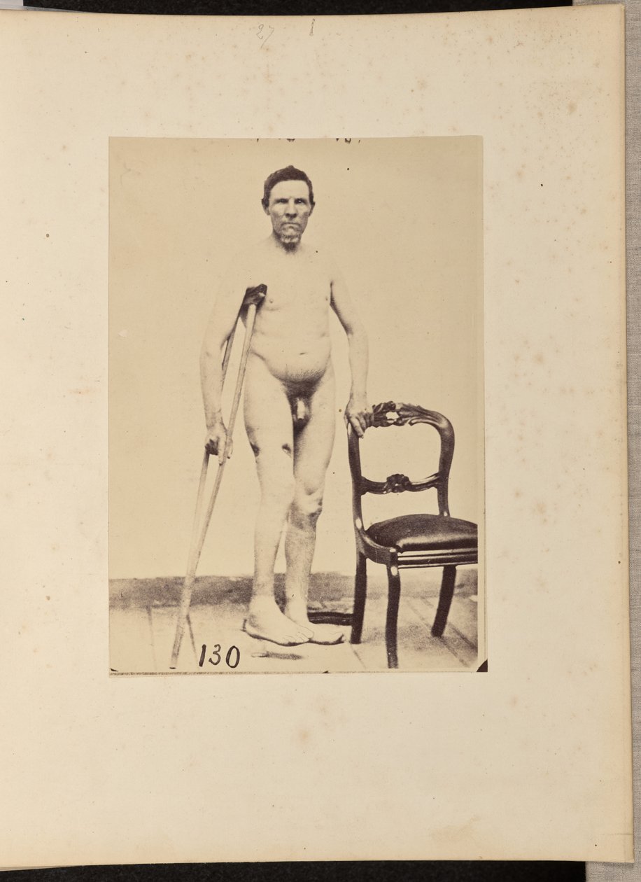 Fratura consolidada por projétil de arma de fogo do terço médio do fémur direito de William H. Bell