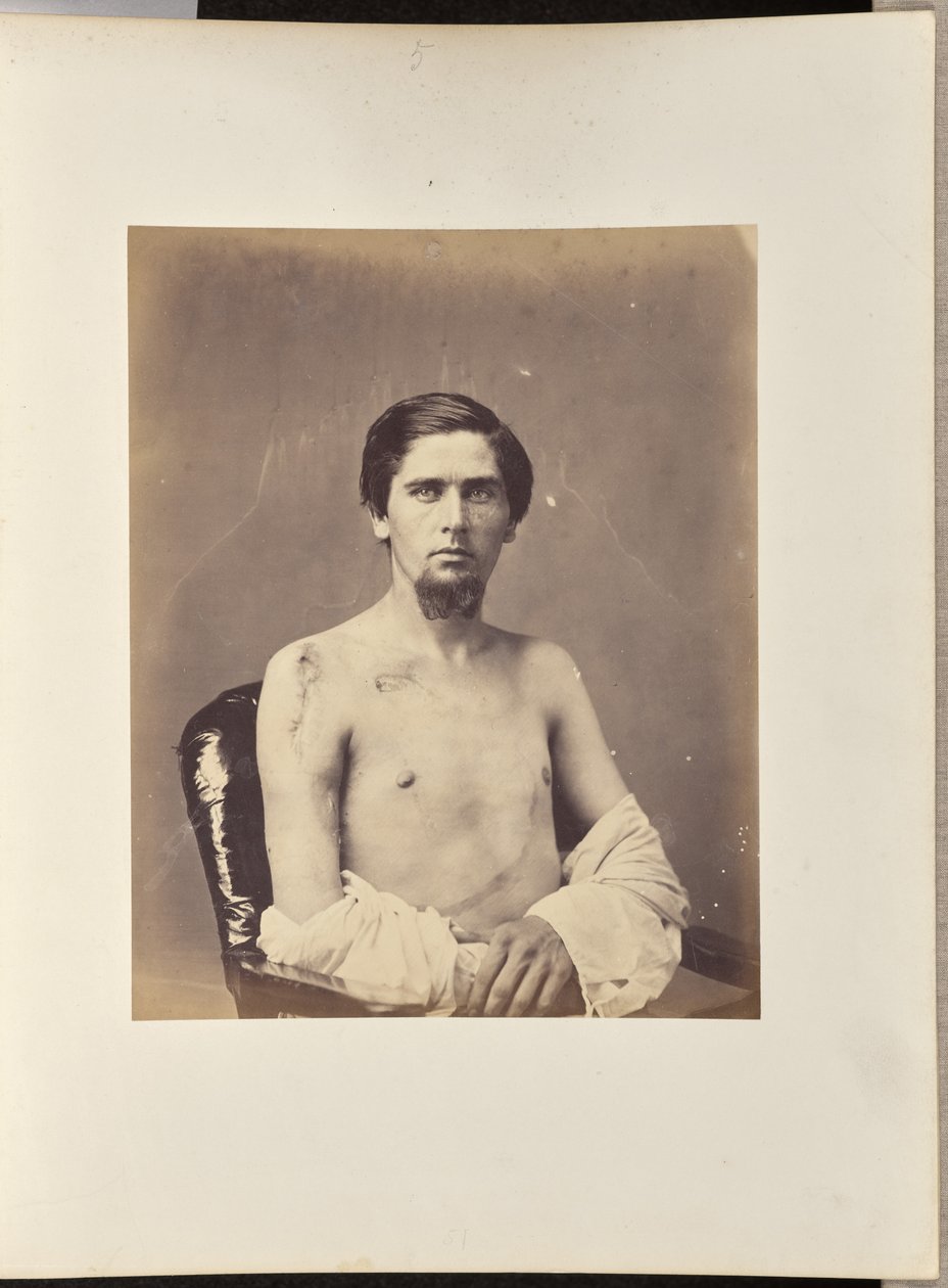 Excisão bem-sucedida da cabeça do úmero direito de William H. Bell