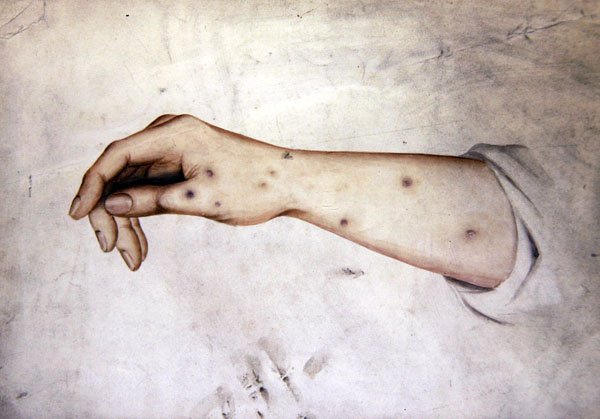 Estudo de um antebraço com condição de pele, c.1850 (aquarela sobre papel) de William Lover