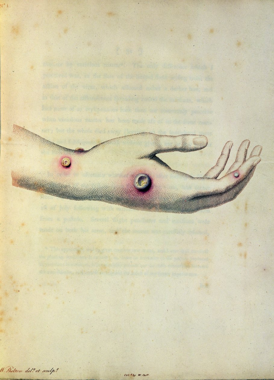 Pústula de varíola bovina no braço de Sarah Nelmes, de "Um Inquérito sobre as Causas e Efeitos das Variolae Vaccinae" de Edward Jenner (1749-1823) gravado por Pearce, c.1800 de William Skelton