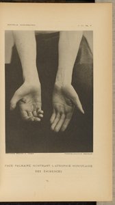 Superfície palmar com atrofia muscular das eminências de Albert Londe