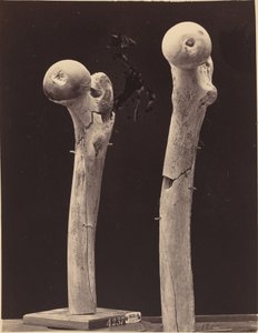 Espécimes de fraturas por arma de fogo do fêmur de American 19th Century