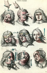 Cirurgia no século XVIII: Trepanação e operação do olho e da cara. Gravura em "Institutionis chirurgicae" de Lorenzo Heister de Anonymous Anonymous
