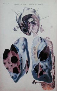 Apoplexia do coração e dos pulmões, placa ilustrativa de "Anatomie pathologique du corps humain" de Jean Cruveilhier (1791-1874), publicado em Paris