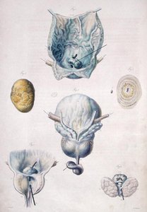 Doenças da bexiga e da próstata, de "Anatomie Pathologique du Corps Humain" de Jean Cruveilhier (1791-1874) 1828-42 (gravura colorida)