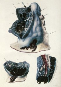 Doenças pulmonares, de "Anatomie Pathologique du Corps Humain" de Jean Cruveilhier (1791-1874) 1828-42 (gravura colorida) de Antoine Chazal