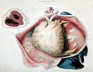 Pericardite, placa representando doenças cardíacas da "Anatomie pathologique du corps humain" de Jean Cruveilhier (1791-1874), publicada em Paris