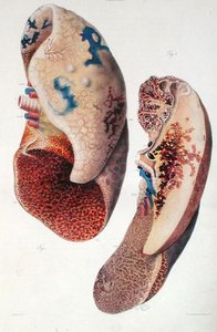 Pneumonia, de 