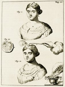 Tratar um doente de epilepsia, a partir dos exercícios práticos para curar método pelo Frederic Dekkers, 1694 de Dutch School