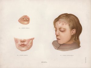 Doenças da pele: Herpes (cor litho) de English School