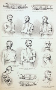 Tratamento Temporário de Fraturas, c.1890 de English School