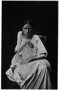 Fotografia de um paciente que sofre de epilepsia hemiplégica, -in "fotografia iconográfica do Salpetrière, Bourneville e P. Regnard, Paris de French Photographer