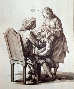 Um médico a operar um doente com cataratas, ilustração da Enciclopédia Médica de Denis Diderot e Jean le Rond d
