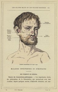 Acidentes característicos de mormo agudo (cor litho) de French School