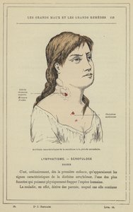 Acidentes característicos de escrofulose no período secundário (cor litho) de French School