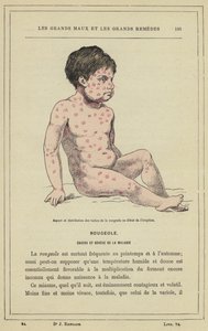 Aspecto e distribuição das manchas de sarampo no início da erupção cutânea (cor litho) de French School