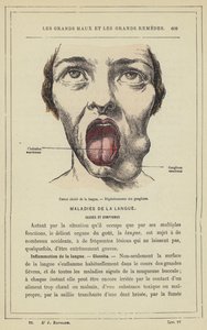 Úlcera de língua cancerígena, Degeneração do nó (cor litho) de French School