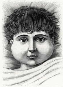 Criança com doença da papeira (gravura) 1888 de French School