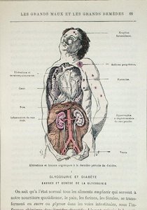 Efeitos do diabetes, de 