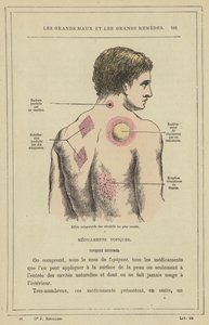 Efeitos comparativos dos revulsivos mais comuns (cor litho) de French School