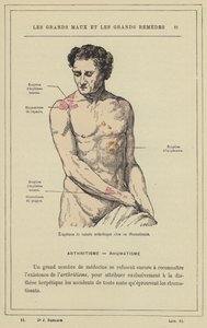Erupção artrítica num paciente reumático (cor litho) de French School