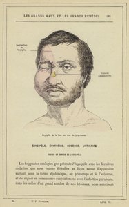 Erysipelas do rosto em progresso (cor litho) de French School