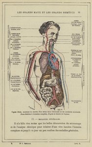 Figura ideal, mostrando a marcha de um vírus na economia e os sucessivos acidentes de uma diátese com evolução completa, de acordo com a teoria do autor (cor litho) de French School