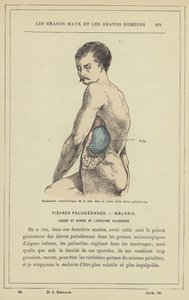 Inchaço característico do baço no decurso de uma febre malária (cor litho) de French School