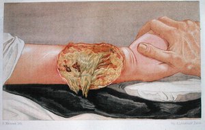 Gangrena do Hospital, de 