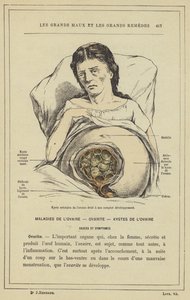 Cisto areolar do ovário direito em seu pleno desenvolvimento (cor litho) de French School
