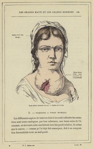 Cisto seroso do pescoço, lipoma da cabeça (cor litho) de French School