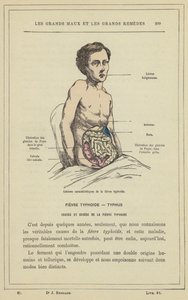 Lesões características da febre tifóide (cor litho) de French School