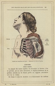 Deslocamento subcoracoide do ombro, deslocamento da cabeça do úmero (cor litho) de French School