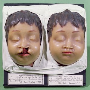 Modelo mostrando o rosto de uma criança antes e depois de uma operação para corrigir uma lipoide realizada por Antoine Dubois (1756-1837) em 1799 (cera) de French School