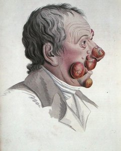 Mycosis Fongoide, de um livro do Barão Jean Louis Alibert (1768-1837) 1838 (gravura a cores) de French School