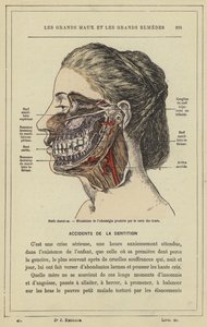 Nervos dentários, Mecanismo de odontologia produzido pela cárie dentária (cor litho) de French School