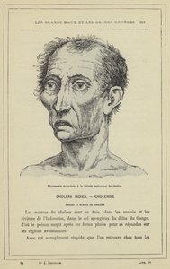 Fisiognomia do paciente durante o período de asfixia da cólera (cor litho) de French School