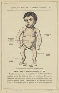 Principais deformações ósseas de uma criança com raquitismo (cor litho) de French School