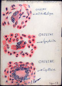 Princípio dos folículos da tuberculose de French School