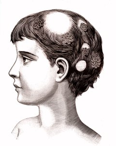 Micose numa criança. 1887 (gravura) de French School