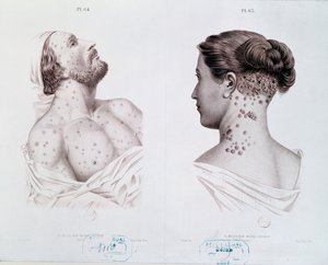 Sintomas da sífilis em homens e mulheres, de um livro médico, c.1850-60 de French School