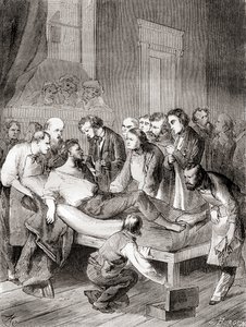 A primeira demonstração pública do uso de éter inalado como anestésico cirúrgico em 1846 por um dentista americano, William Thomas Green Morton, de 