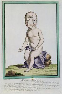 Criança com uma cabeça deformada, de &39;Les Ecarts de la Nature&39;, Paris, 1775