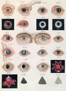 Descrição das anomalias congênitas dos olhos, de Representações Clínicas de Doenças e Erros Cegantes do Olho Mesnschlichen, de Friedrich August von Ammon (1799-1861) 1838 de German School