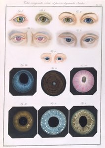 Descrição das anomalias congênitas dos olhos, de Representações Clínicas de Doenças e Erros Cegantes do Olho Mesnschlichen, de Friedrich August von Ammon (1799-1861) 1838 de German School