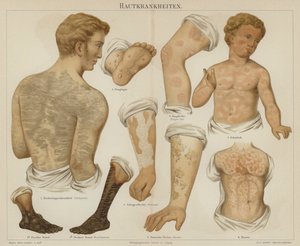 Distúrbios cutâneos (cor litho) de German School