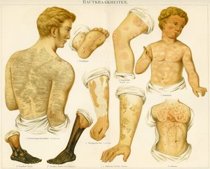 Afecções da pele, c.1890 de German School