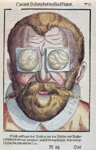 Tratar de uma condição de olho, de Ophthalmodouleia por Georg Bartisch (1535-1636) publicou em Dresden em 1583 (impressão de woodblock de cor) de German School